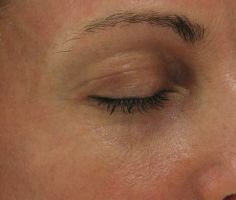 Fraxel re:pair CO2 laser resurfacing for eyes (Nonsurgical Blepharoplasty)