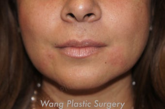 Juvederm to improve marionette lines