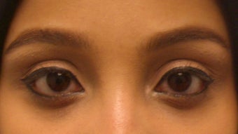 Restylane to the tear trough