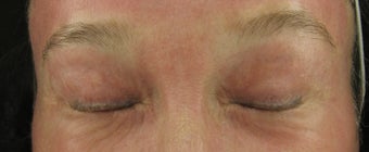 Fraxel re:pair (repair) CO2 laser resurfacing