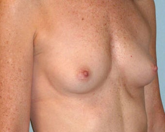 Breast Augmentation 