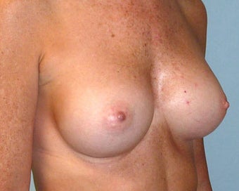 Breast Augmentation 