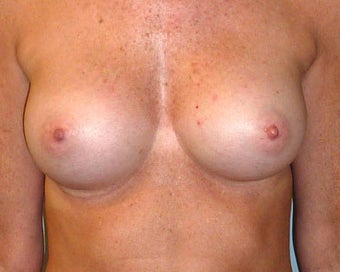 Breast Augmentation 