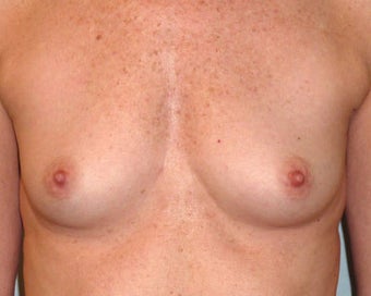 Breast Augmentation 