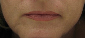 Fraxel re:pair (repair) for lip lines and lip enhancement