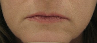 Fraxel re:pair (repair) for lip lines and lip enhancement
