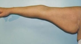 44 year old woman who underwent an arm lift 