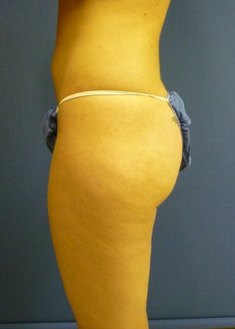 Liposuction of Buttock and Thighs