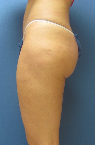 Liposuction of Buttock and Thighs