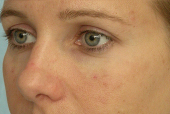 Restylane
