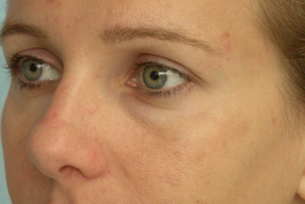 Restylane
