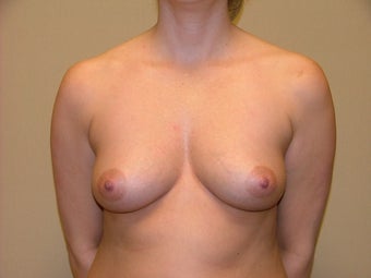 Breast Implants