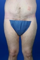 36 Year Old Weight Loss Patient Treated With Medial Thigh Lift