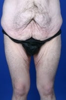 36 Year Old Weight Loss Patient Treated With Medial Thigh Lift
