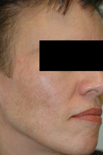 Melasma Los Angeles - No Laser Treatment