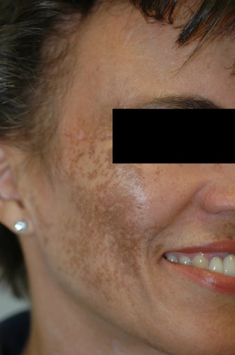 Melasma Los Angeles - No Laser Treatment
