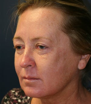 Lip Lift and Corner Lift