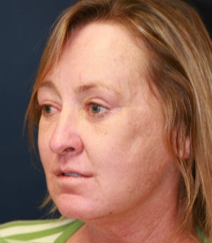 Lip Lift and Corner Lift