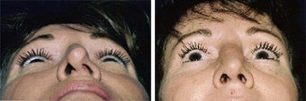 Before and after septoplatsy