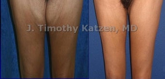 Thigh Lift after massive weight loss