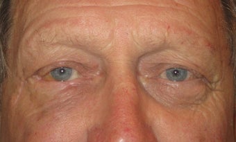 Eyelid skin cancer surgery