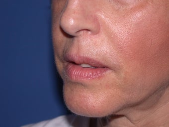 Injectable Fillers