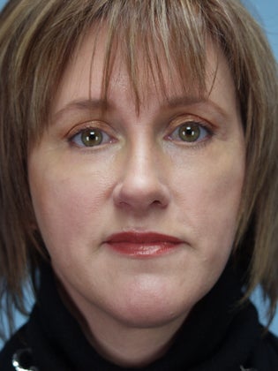Lower Eyelid Hetter Peel