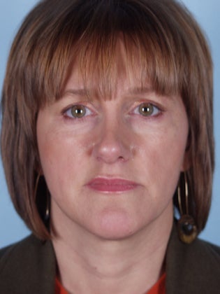 Lower Eyelid Hetter Peel