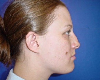 Septoplasty and Rhinoplasty, Nose surgery