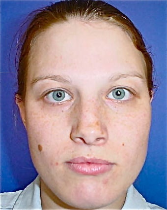 Septoplasty and Rhinoplasty, Nose surgery