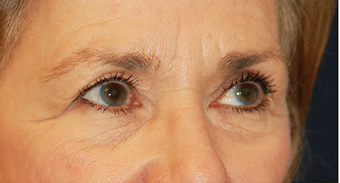 Eye Bag Surgery