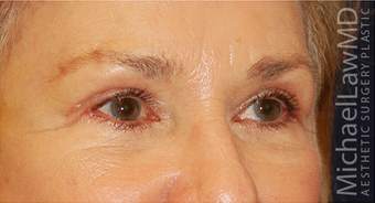 Eye Bag Surgery