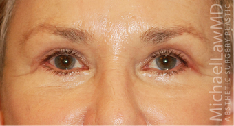 Eye Bag Surgery