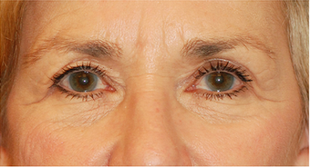 Eye Bag Surgery