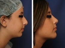 Rhinoplasty and chin implant