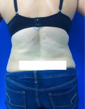 Laser Lipo