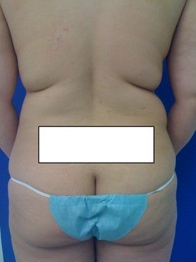 Laser Lipo