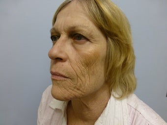 Ablative Laser Resurfacing 