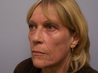 Ablative Laser Resurfacing 