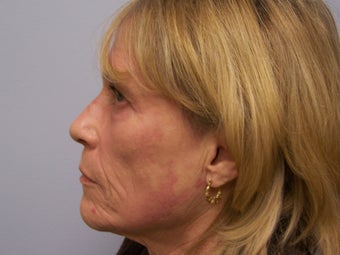 Ablative Laser Resurfacing 