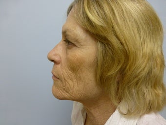 Ablative Laser Resurfacing 