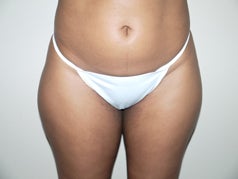 Liposuction 
