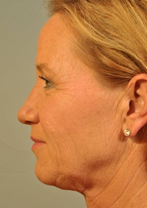Lower lid Hetter Peel