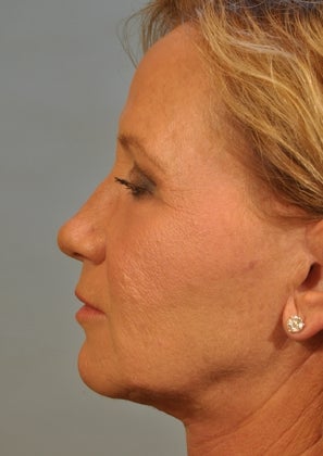 Lower lid Hetter Peel