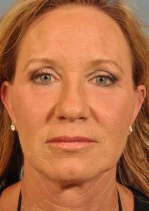 Lower lid Hetter Peel