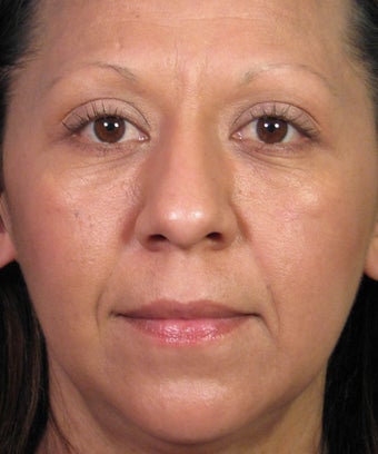 Mole Removal Example from Left Cheek