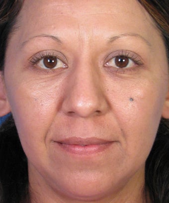 Mole Removal Example from Left Cheek