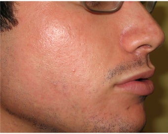 Intense Pulsed Light for Acne