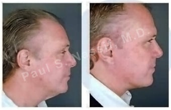 Lower Face and Neck Lift.