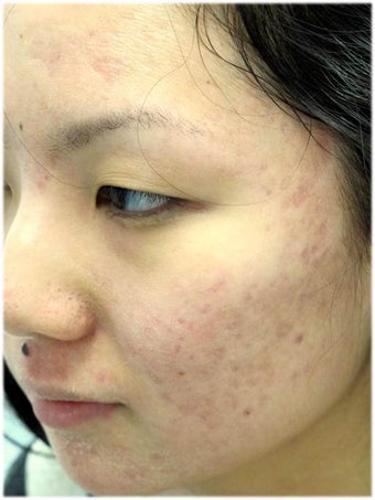 Acne Therapy